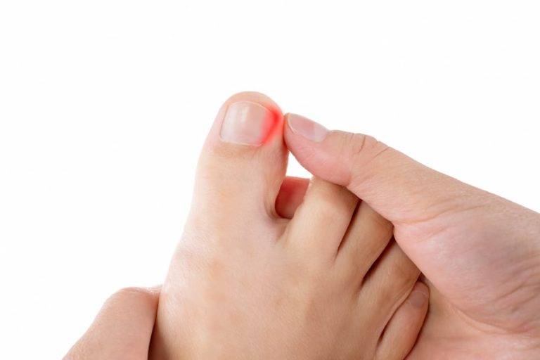 A big toe with an Ingrown Toenail highlighted in red